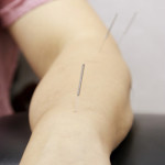 Acupuncture and Moxibustion Therapy- thumbnail